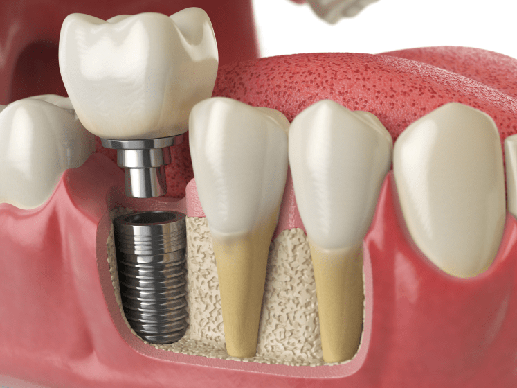 Уникальные методы лечения и имплантации зубов в клинике Бокой